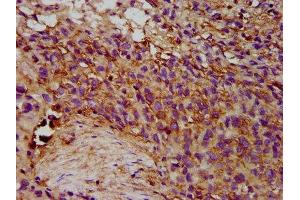 IHC image of ABIN7151818 diluted at 1:300 and staining in paraffin-embedded human ovarian cancer performed on a Leica BondTM system. (EPX anticorps  (AA 140-300))