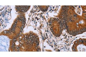 Immunohistochemistry of paraffin-embedded Human colon cancer tissue using IHH Polyclonal Antibody at dilution 1:30 (Indian Hedgehog anticorps)