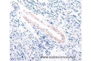Immunohistochemistry of Human gastric cancer using TPM1 Polyclonal Antibody at dilution of 1:80 (Tropomyosin anticorps)