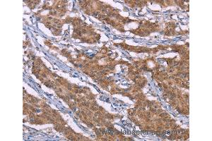 Immunohistochemistry of Human liver cancer using HRH3 Polyclonal Antibody at dilution of 1:40 (HRH3 anticorps)