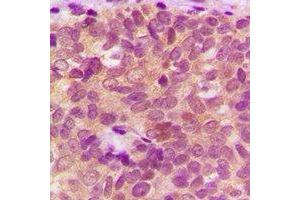 Immunohistochemical analysis of IDE staining in human breast cancer formalin fixed paraffin embedded tissue section.