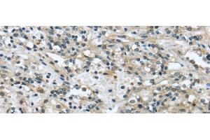 Immunohistochemistry of paraffin-embedded Human prostate cancer tissue using VPS4A Polyclonal Antibody at dilution 1:40 (VPS4A anticorps)