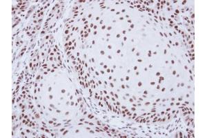 IHC-P Image Immunohistochemical analysis of paraffin-embedded Cal27 xenograft, using SART1, antibody at 1:500 dilution. (SART1 anticorps  (Internal Region))