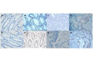 Immunohistochemistry for MLH1 and MSH2 protein expression (hematoxylin, 400x).