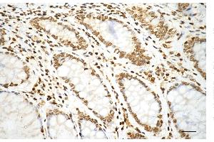 Immunohistochemistry was performed on paraffin-embedded human sigmoid colon carcinoma using histone H3 (mono methyl K79) antibody (ABIN7798961), 1:200).