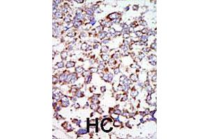 Formalin-fixed and paraffin-embedded human hepatocellular carcinoma tissue reacted with the MAP3K7 polyclonal antibody , which was peroxidase-conjugated to the secondary antibody, followed by AEC staining. (MAP3K7 anticorps  (C-Term))