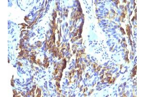 Formalin-fixed, paraffin-embedded human Tongue stained with Melanoma Monoclonal Antibody (KBA. (Melanoma Associated Antigen (KBA.62) anticorps)