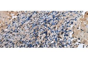 Immunohistochemistry of paraffin-embedded Human lung cancer tissue using ABHD14B Polyclonal Antibody at dilution of 1:30(x200) (ABHD14B anticorps)