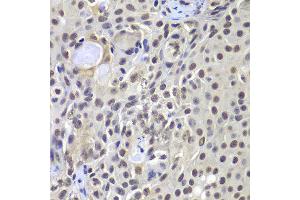 Immunohistochemistry of paraffin-embedded human well-differentiated squamous skin carcinoma using PRKDC antibody at dilution of 1:100 (x400 lens).