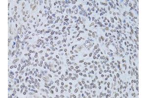 Immunohistochemistry of paraffin-embedded human adenomyosis using LMNB2 Antibody (ABIN5973877) at dilution of 1/100 (40x lens). (Lamin B2 anticorps)