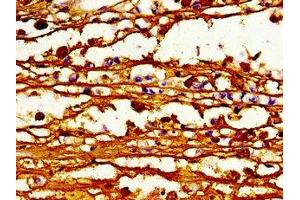 Immunohistochemistry of paraffin-embedded human melanoma using ABIN7163123 at dilution of 1:100