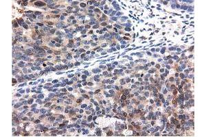 Immunohistochemical staining of paraffin-embedded Carcinoma of Human kidney tissue using anti-QPRT mouse monoclonal antibody. (QPRT anticorps)
