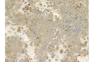 ABIN6257016 and ABIN6274443 at 1/100 staining human melanoma by IHC-P. (EPS8-Like 1 anticorps  (Internal Region))