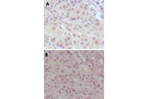 Immunohistochemical analysis of paraffin-embedded human lung cancer (A) and esophagus cancer (B), showing nuclear weak staining with DAB staining using MLL monoclonal antibody, clone 10F8D7 . (MLL/KMT2A anticorps)