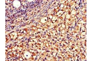 Immunohistochemistry of paraffin-embedded human ovarian cancer using ABIN7149920 at dilution of 1:100