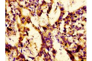 Immunohistochemistry of paraffin-embedded human gastric cancer using ABIN7158434 at dilution of 1:100 (LBP anticorps  (AA 304-414))