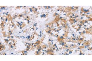 Immunohistochemistry of paraffin-embedded Human thyroid cancer tissue using IAPP Polyclonal Antibody at dilution 1:40 (Amylin/DAP anticorps)