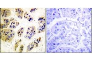 Immunohistochemistry analysis of paraffin-embedded human breast carcinoma, using CBL (Phospho-Tyr700) Antibody. (CBL anticorps  (pTyr700))
