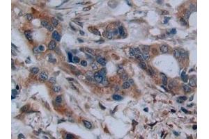 Detection of C2CD3 in Human Pancreatic cancer Tissue using Polyclonal Antibody to C2 Calcium Dependent Domain Containing Protein 3 (C2CD3) (C2CD3 anticorps  (AA 1432-1647))