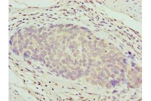 Immunohistochemistry of paraffin-embedded human gastric cancer using ABIN7176132 at dilution of 1:100 (ZNF177 anticorps  (AA 1-321))