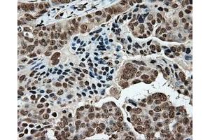 Immunohistochemical staining of paraffin-embedded Adenocarcinoma of colon tissue using anti-MCL1 mouse monoclonal antibody. (MCL-1 anticorps)