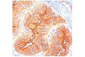 IHC staining of human colon cancer with TAG-72 antibody (TAG-72 anticorps)