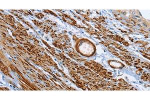Immunohistochemistry of paraffin-embedded Human cervical cancer tissue using SHROOM2 Polyclonal Antibody at dilution 1:50 (SHROOM2 anticorps)