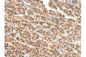 The image on the left is immunohistochemistry of paraffin-embedded Human liver cancer tissue using ABIN7128081(VIL1 Antibody) at dilution 1/30, on the right is treated with fusion protein. (Villin 1 anticorps)