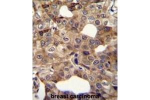 CCNI2 Antibody (Center) immunohistochemistry analysis in formalin fixed and paraffin embedded human breast carcinoma followed by peroxidase conjugation of the secondary antibody and DAB staining. (CCNI2 anticorps  (Middle Region))