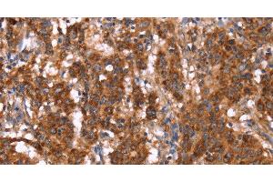 Immunohistochemistry of paraffin-embedded Human gastric cancer tissue using GAGE12I Polyclonal Antibody at dilution 1:30 (G Antigen 12I anticorps)