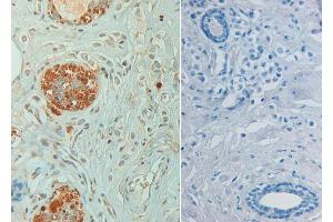Immunohistochemistry of Rabbit anti STAT6 pY641 Antibody in human breast carcinoma pH 9(left) with negative control (right) Tissue: Human breast carcinoma