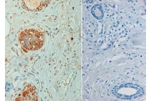Immunohistochemistry of Rabbit anti STAT6 pY641 Antibody in human breast carcinoma pH 9(left) with negative control (right) Tissue: Human breast carcinoma (STAT6 anticorps  (Internal Region, pTyr641))