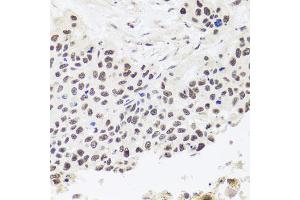 Immunohistochemistry of paraffin-embedded human lung cancer using RPP30 antibody. (RPP30 anticorps)