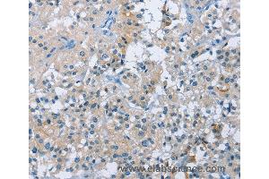 Immunohistochemistry of Human thyroid cancer using BTN2A2 Polyclonal Antibody at dilution of 1:50 (BTN2A2 anticorps)