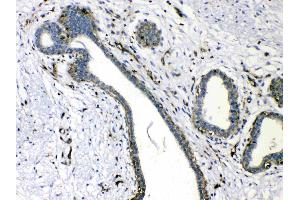 VASP was detected in paraffin-embedded sections of human mammary cancer tissues using rabbit anti- VASP Antigen Affinity purified polyclonal antibody (Catalog # ) at 1 µg/mL.