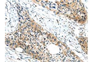 The image on the left is immunohistochemistry of paraffin-embedded Human esophagus cancer tissue using ABIN7190846(GPR15 Antibody) at dilution 1/20, on the right is treated with synthetic peptide. (GPR15 anticorps)
