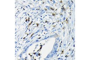 Immunohistochemistry of paraffin-embedded human colon carcinoma using NF Rabbit pAb (ABIN6130595, ABIN6144558, ABIN6144559 and ABIN6222368) at dilution of 1:200 (40x lens). (NFATC3 anticorps  (AA 1-290))