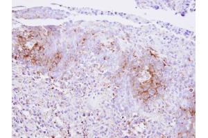 IHC-P Image Immunohistochemical analysis of paraffin-embedded SAS xenograft , using Calcium Sensing Receptor, antibody at 1:500 dilution. (CASR anticorps)