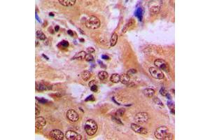 Immunohistochemical analysis of p53 (AcK386) staining in human lung cancer formalin fixed paraffin embedded tissue section. (p53 anticorps  (acLys386, C-Term))