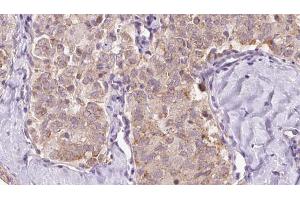 ABIN6273351 at 1/100 staining Human thyroid cancer tissue by IHC-P. (ZFYVE16 anticorps  (C-Term))