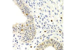 Immunohistochemistry of paraffin-embedded human uterine cancer using GEMIN2 Antibody. (SIP1 anticorps)