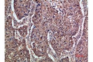 Immunohistochemical analysis of paraffin-embedded human-lung-cancer, antibody was diluted at 1:200 (IFNAR1 anticorps  (AA 300-350))