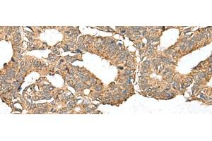 Immunohistochemistry of paraffin-embedded Human colorectal cancer tissue using AHNAK Polyclonal Antibody at dilution of 1:50(x200) (AHNAK anticorps)