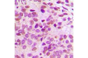 Immunohistochemical analysis of GATA3 staining in human breast cancer formalin fixed paraffin embedded tissue section.