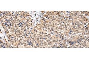 Immunohistochemistry of paraffin-embedded Human breast cancer using TBL1X Polyclonal Antibody at dilution of 1/30 (TBL1X anticorps)
