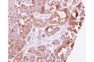 IHC-P Image Guanylate kinase antibody detects GUK1 protein at cytosol on CX-1 xenograft by immunohistochemical analysis.