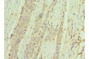 Immunohistochemistry of paraffin-embedded human colon cancer using ABIN7156926 at dilution of 1:100 (IL7R anticorps  (AA 21-239))