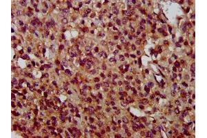 IHC image of ABIN7173123 diluted at 1:400 and staining in paraffin-embedded human glioma performed on a Leica BondTM system. (TMEM192 anticorps  (AA 193-271))