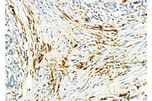 ABIN6259473 and ABIN6275568 at 1/100 staining Human pancreatic cancer and adjacent nomal tissues by IHC-P. (SH3RF3 anticorps  (C-Term))