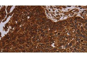 Immunohistochemistry of paraffin-embedded Human lung cancer tissue using NDUFAB1 Polyclonal Antibody at dilution 1:50 (NDUFAB1 anticorps)